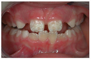 Eroze a restaurování zubní skloviny