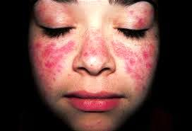 Příznaky nemoci lupus